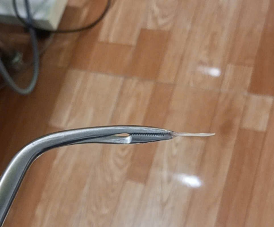 HÓC XƯƠNG CÁ: HIỂM HỌA KHÔN LƯỜNG