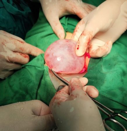 Thêm một ca phẫu thuật cắt u nang buồng trứng thành công tại Bệnh viện đa khoa Nà Chì